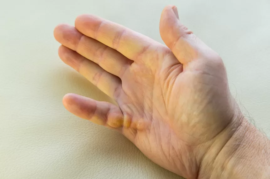 Dupytren kontraktürü