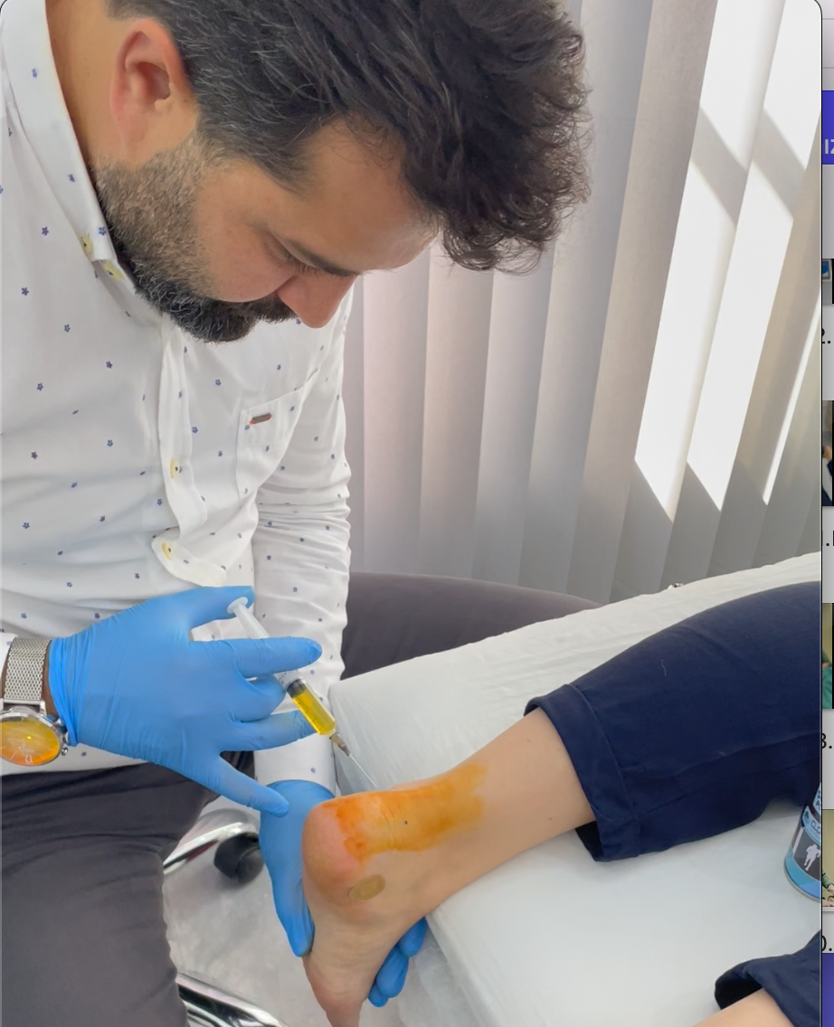 Aşil Tendonu Nedir? - Aşil Tendonu Kopması Nasıl Olur?