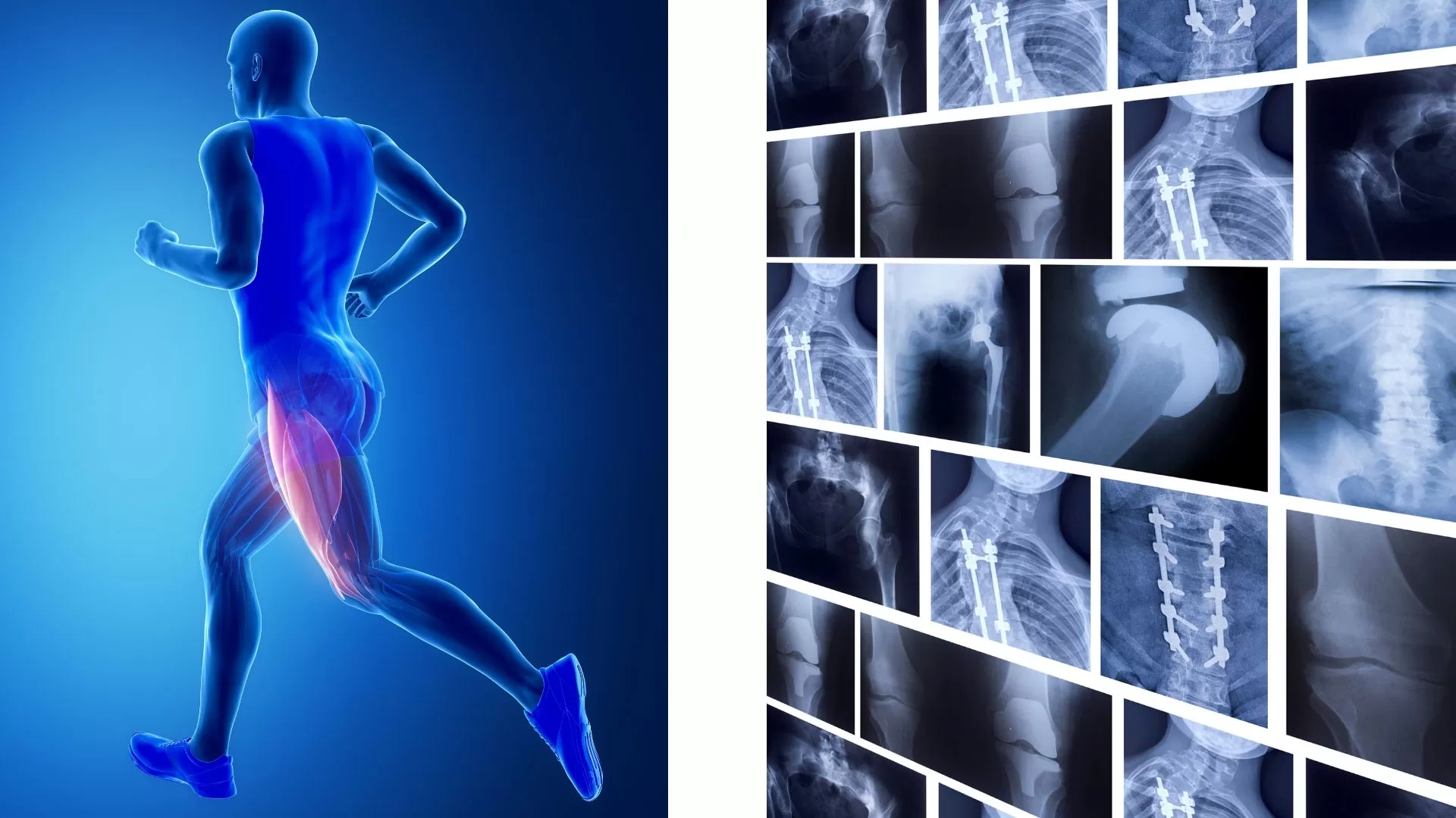 Sporcularda Kas Tendon Yaralanmaları