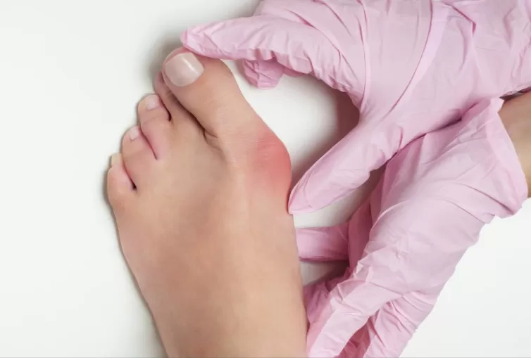 Halluks Valgus