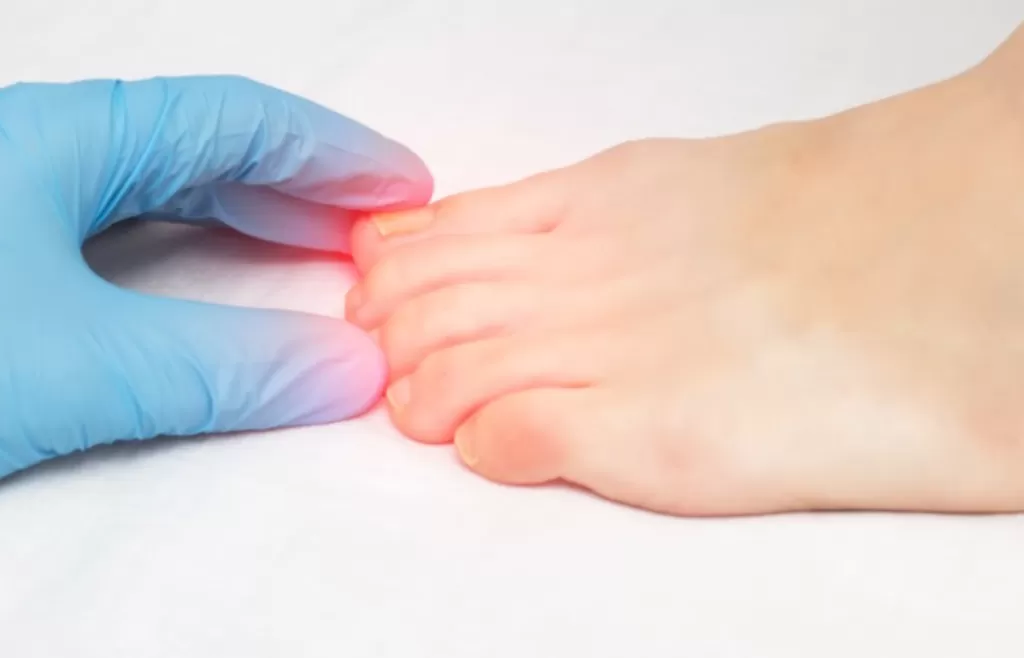 Tırnak Batması - MSM Klinik