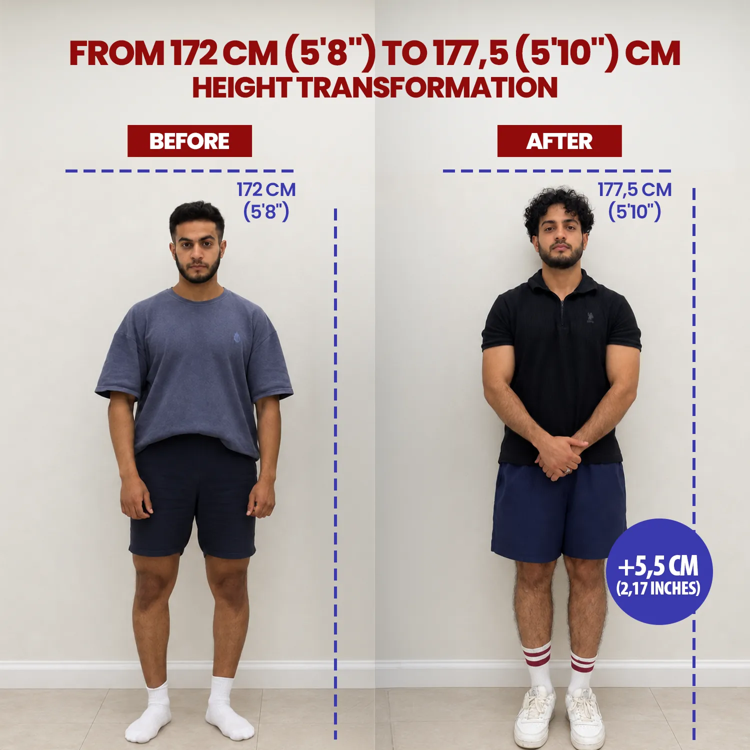Combined before and after photograph of a limb lengthening patient, 172 to 177 cm