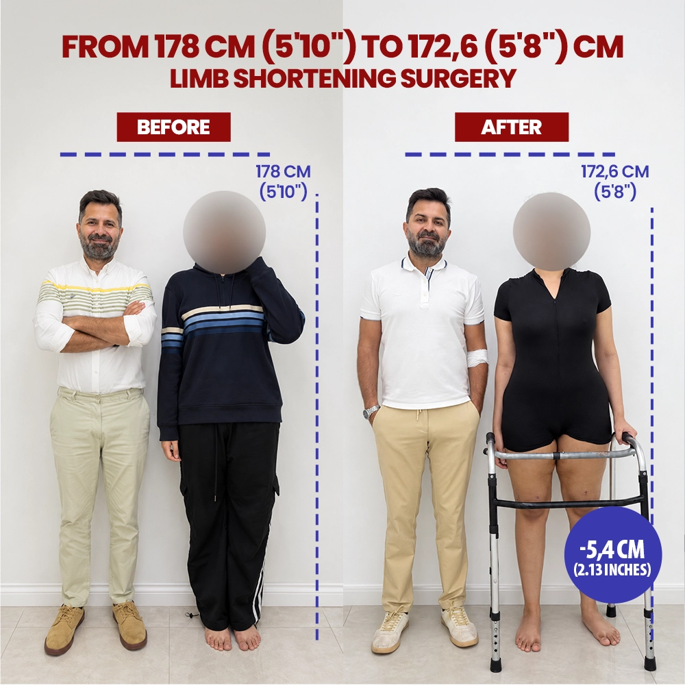 Combined before and after photograph of a limb shortening patient, 178 cm reduced to 172 cm