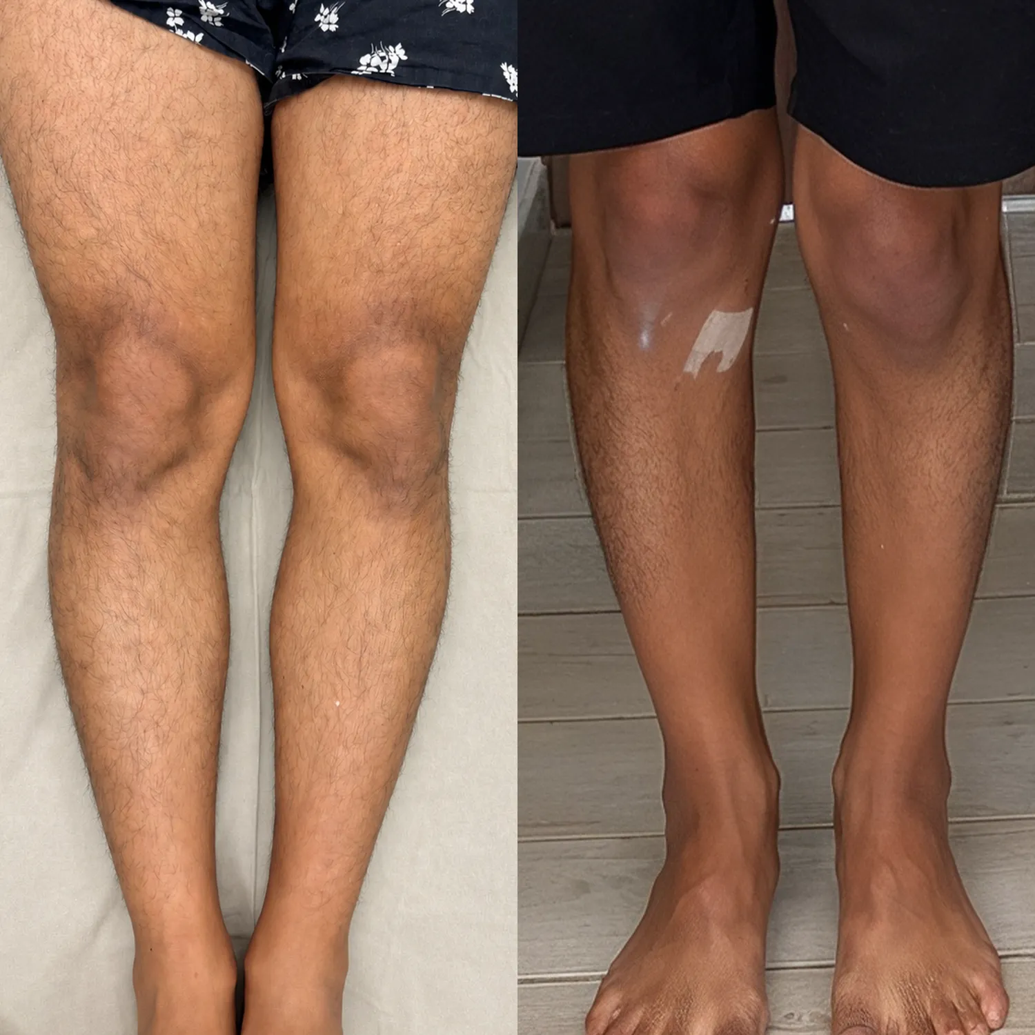 Combined before and after photograph of a bow leg correction patient