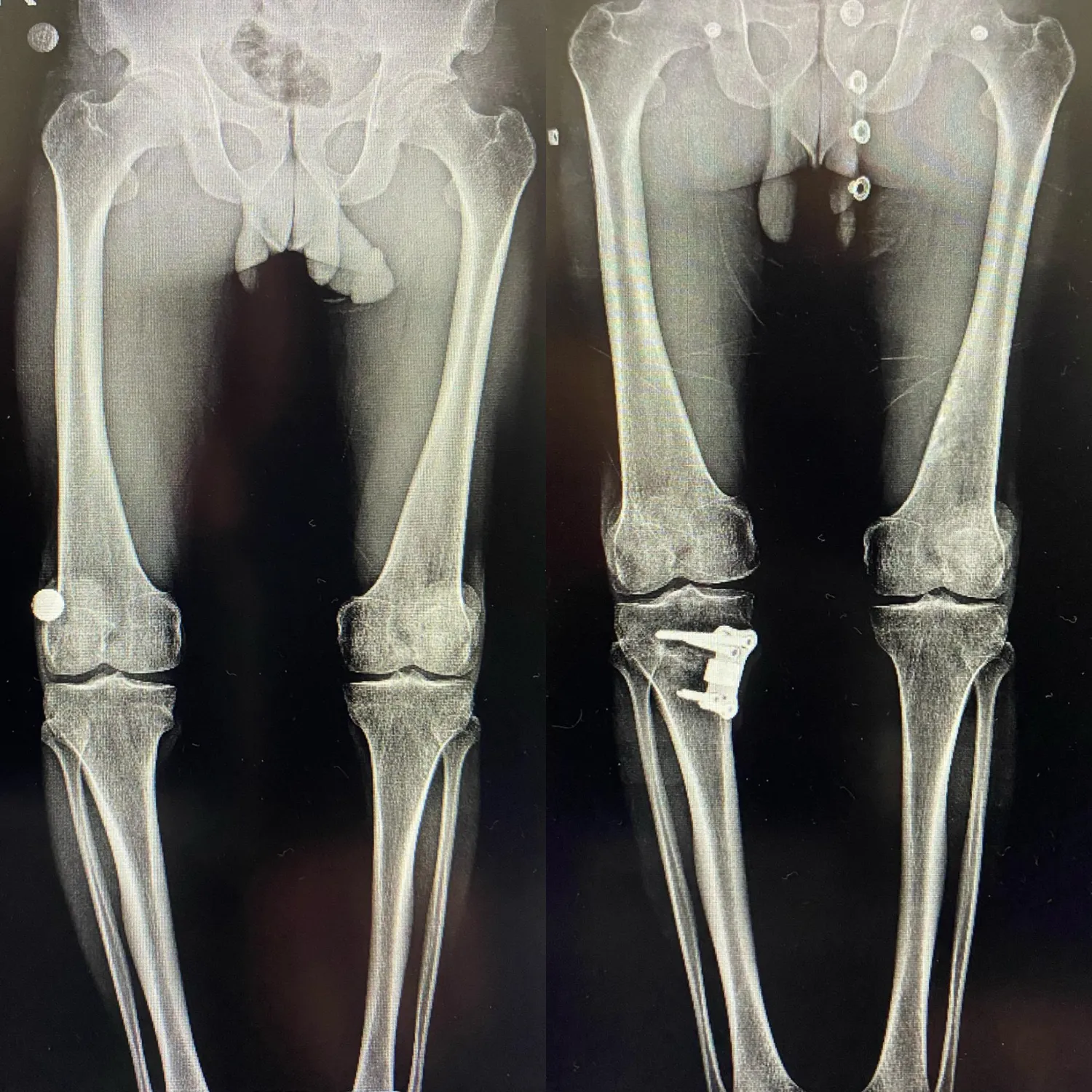 Combined before and after photograph of a leg alignment correction patient
