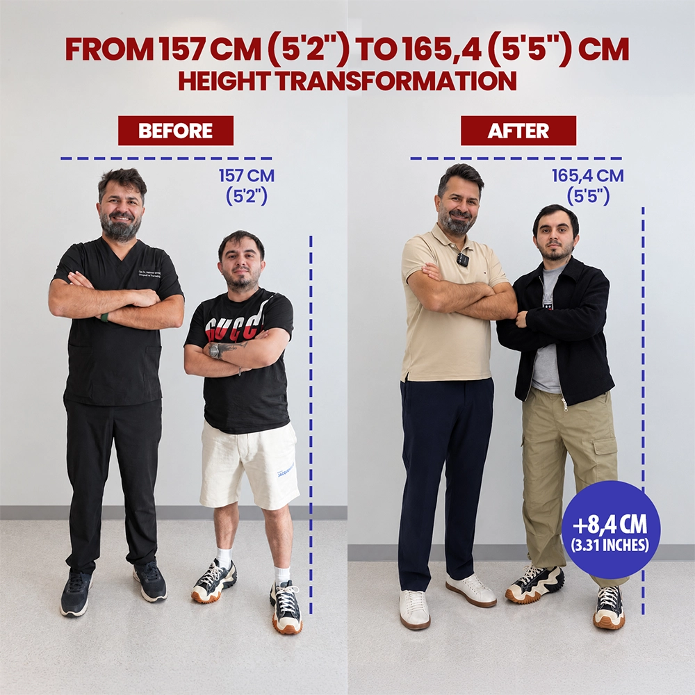 Combined before and after photograph of Muzaffer, limb lengthening patient, 157 to 164 cm