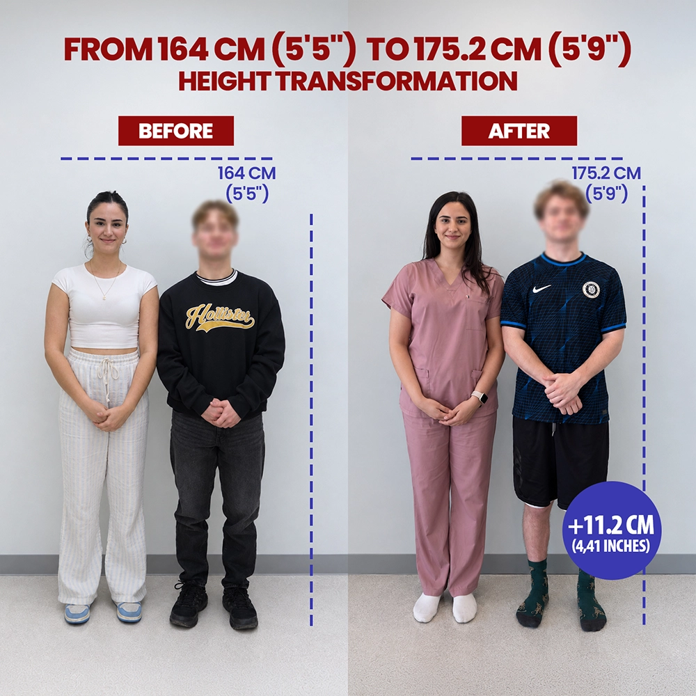Combined before and after photograph of Samuel, limb lengthening patient, 164 to 175 cm