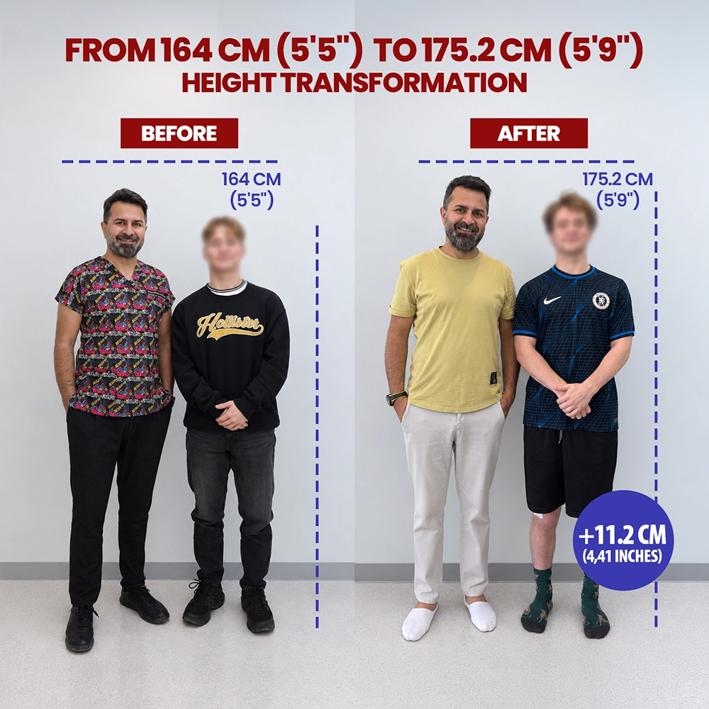 Second view of Samuel, limb lengthening patient, before and after treatment